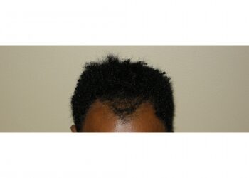 African American Hair Restoration