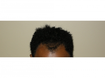African American Hair Restoration