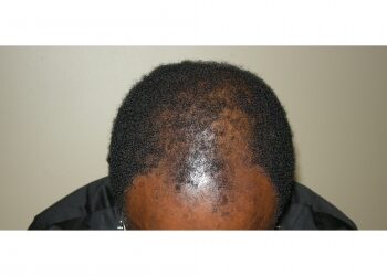 African American Hair Transplant In Houston