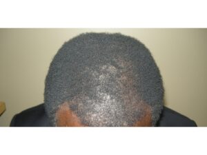 African American Hair Transplant In Houston