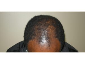 African American Hair Transplant Houston