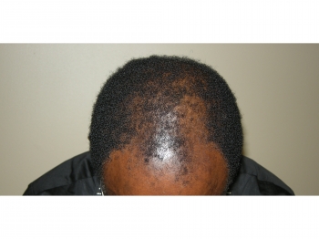 African American Hair Transplant In Houston
