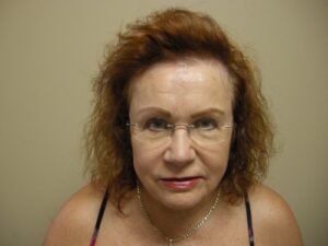 Female Hair Restoration Houston | Hair Restoration Houston