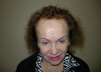 Female Hair Restoration In Houston