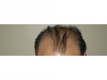 Men’s Hair Loss Procedure In Houston