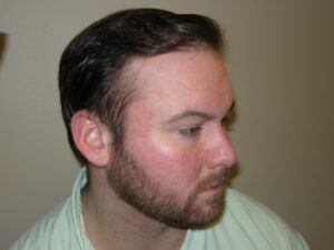 Men's Hair Loss Recovery Houston | PHRC