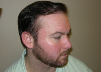 Men’s Hair Loss Recovery In Houston