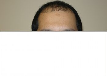 Men’s Hair Loss Solution In Houston
