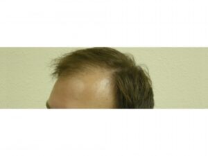 Men's Hair Loss Surgery | Hair Restoration Houston