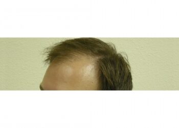 Men’s Hair Loss Surgery In Houston