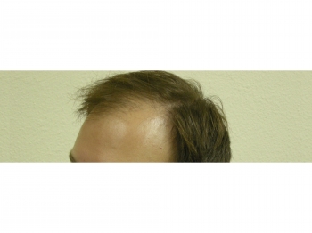 Men’s Hair Loss Surgery In Houston