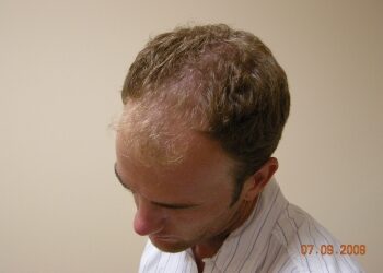Men’s Hair Loss Treatment In Houston
