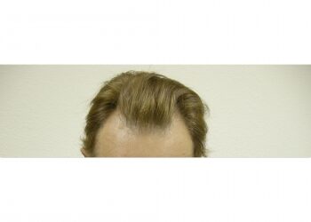 Male Hair Restoration Houston