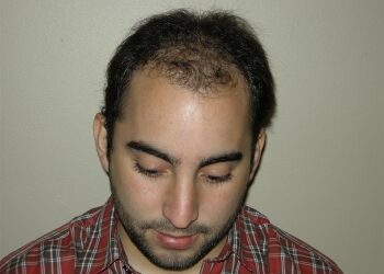 Hair Restoration Procedure In Houston