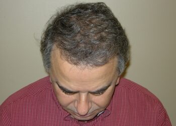 Hair Restoration Results Houston