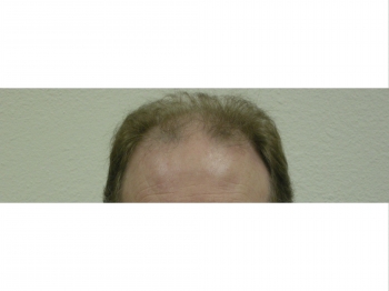 Male Hair Restoration Surgery In Houston