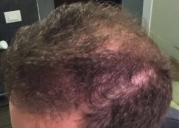 Male Hair Transplant Surgery Results