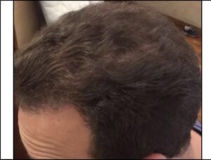 Male Transplant Surgery Results | Hair Restoration Houston