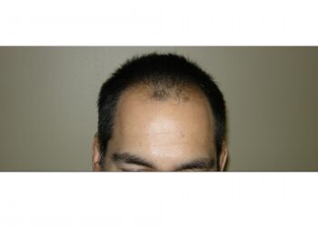 Men’s Hair Transplants In Houston