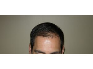 Men's Hair Transplants In Houston | Hair Restoration Houston