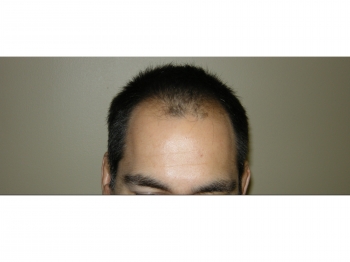 Men’s Hair Transplants In Houston