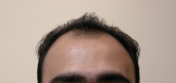 Men’s Hair Transplant Results In Houston