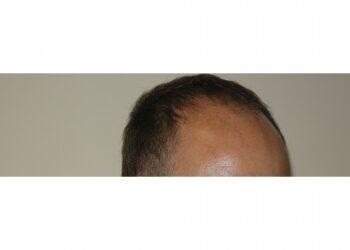 Men’s Hair Transplant Surgery Houston