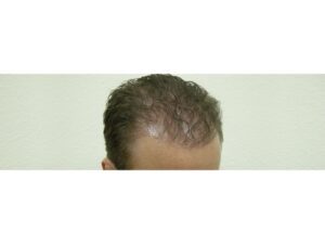 Male Hair Transplant Surgery Houston