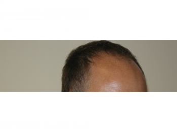 Men’s Hair Transplant Surgery Houston