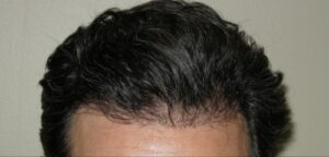 Houston Hair Transplant For Men | Hair Restoration Houston