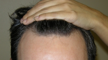 Houston Hair Transplant For Men