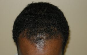 Men's Hair Restoration In Houston | Hair Restoration Houston