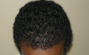 Men's Hair Restoration In Houston | Hair Restoration Houston