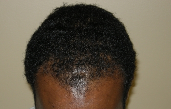 Men’s Hair Restoration In Houston