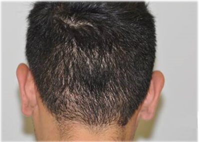 FUE Hair Donor Transplant Area