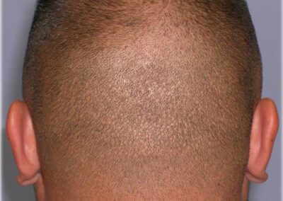 FUE donor scar patient with shaved head - Hair Restoration