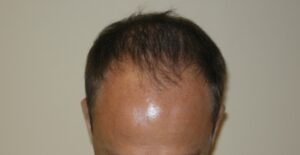 Hair Loss Solutions For Thinning Hair | Hair Restoration Houston
