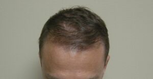 Hair Loss Solutions For Thinning Hair | Hair Restoration HoustonHair Loss Solutions For Thinning Hair | Hair Restoration Houston