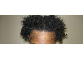 Women’s Hair Restoration In Houston