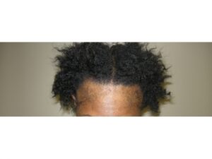 Women's Hair Restoration | Hair Restoration Houston