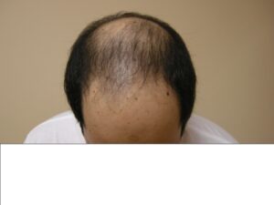 Men's Hair Loss Solution In Houston | Hair Restoration Houston