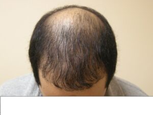 Men's Hair Loss Solution In Houston | Hair Restoration Houston
