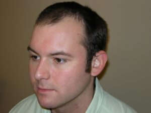 Men's Hair Loss Recovery In Houston