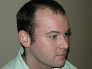 Men's Hair Loss Recovery In Houston | PHRC