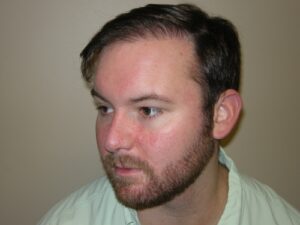 Men's Hair Loss Recovery In Houston | Hair Restoration Houston