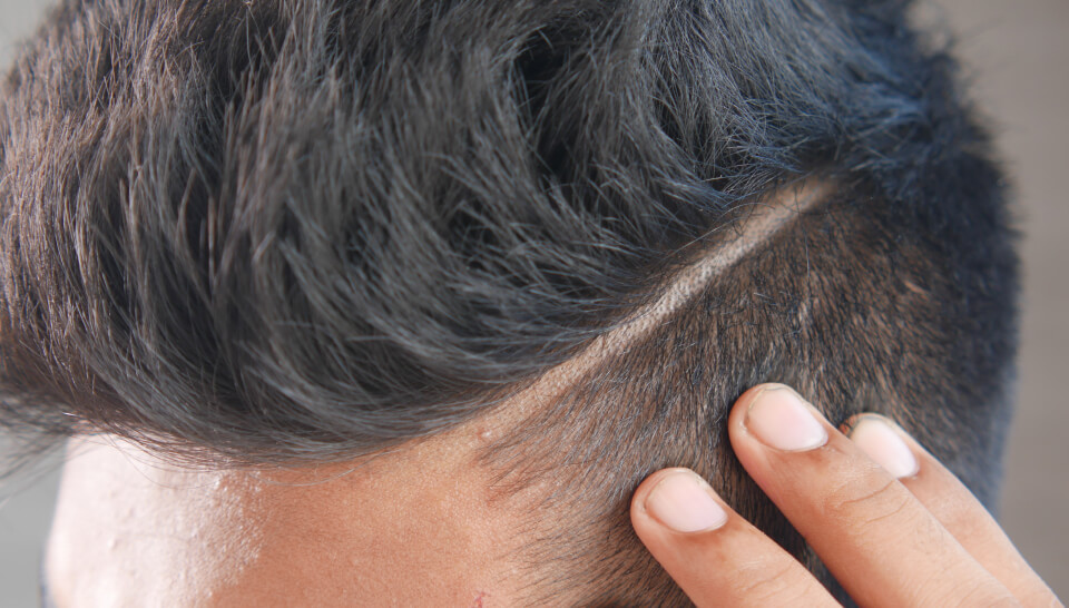 fue-procedure-img